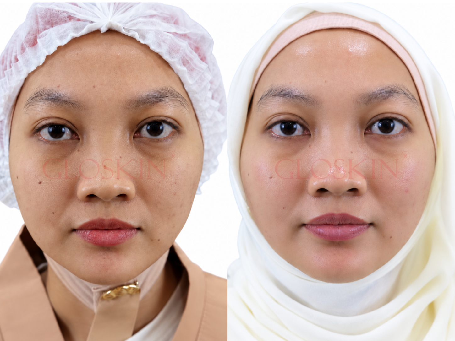 Exxoskin
