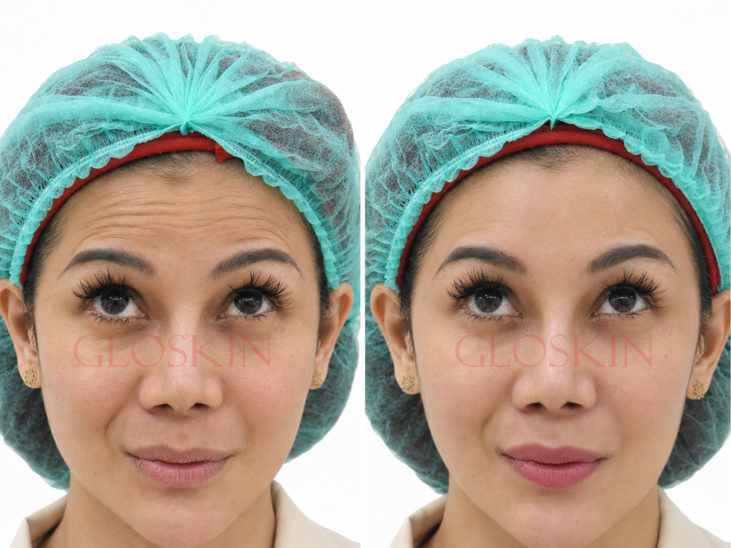 Botox - Gambar 6