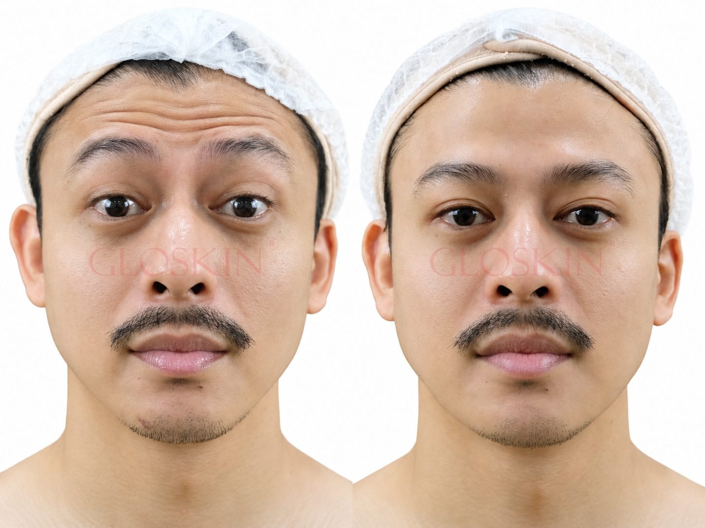 Botox