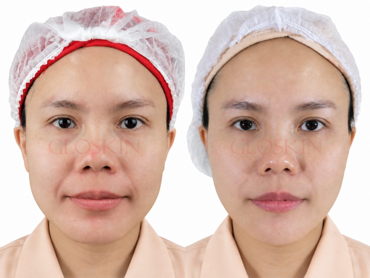 Botox