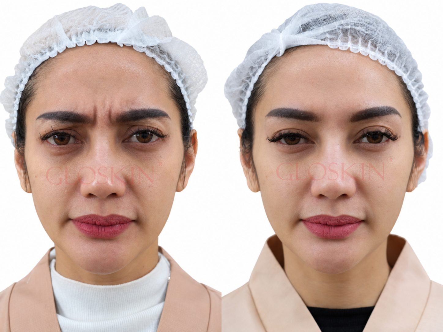 Botox
