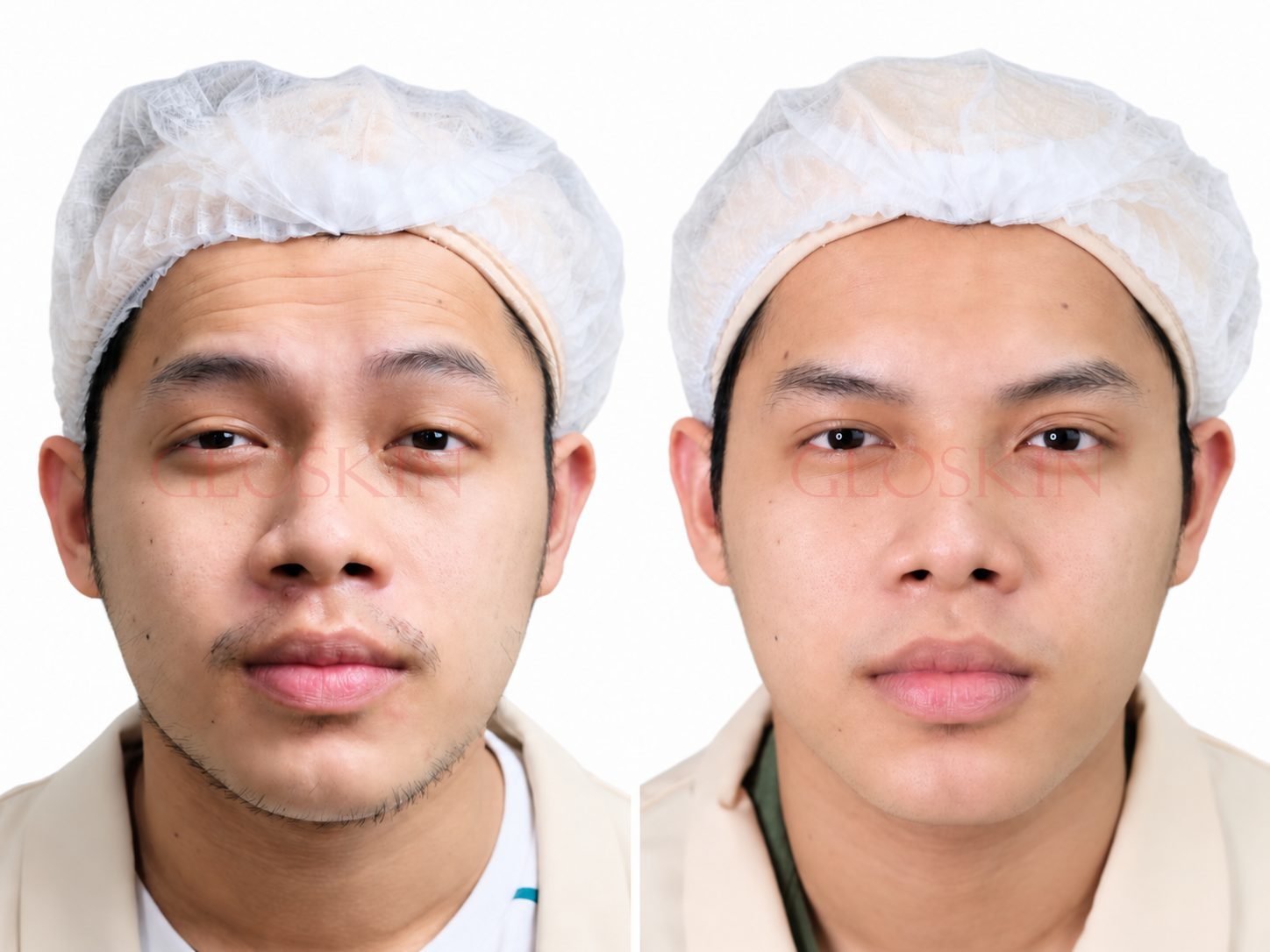 Botox