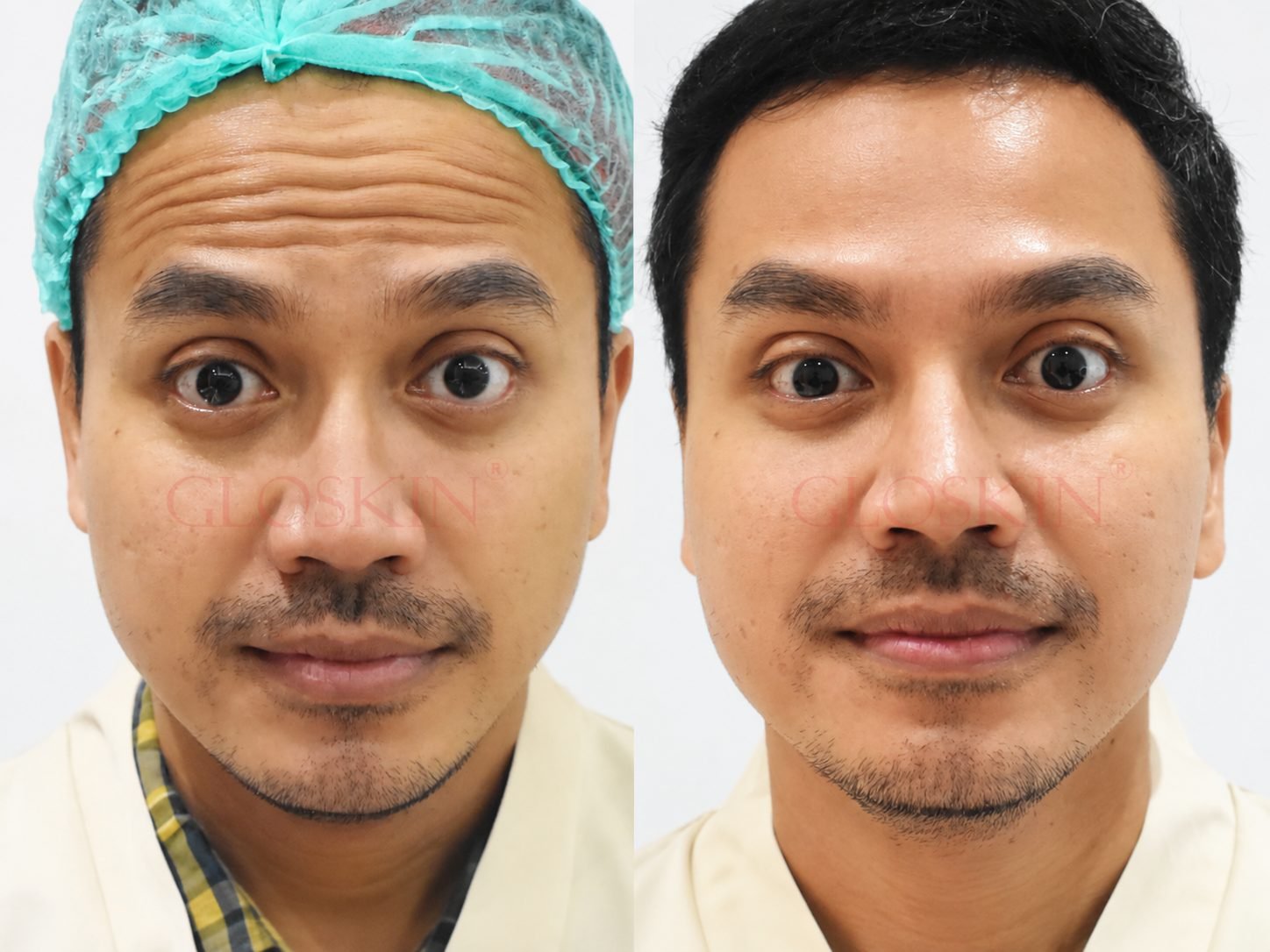 Botox