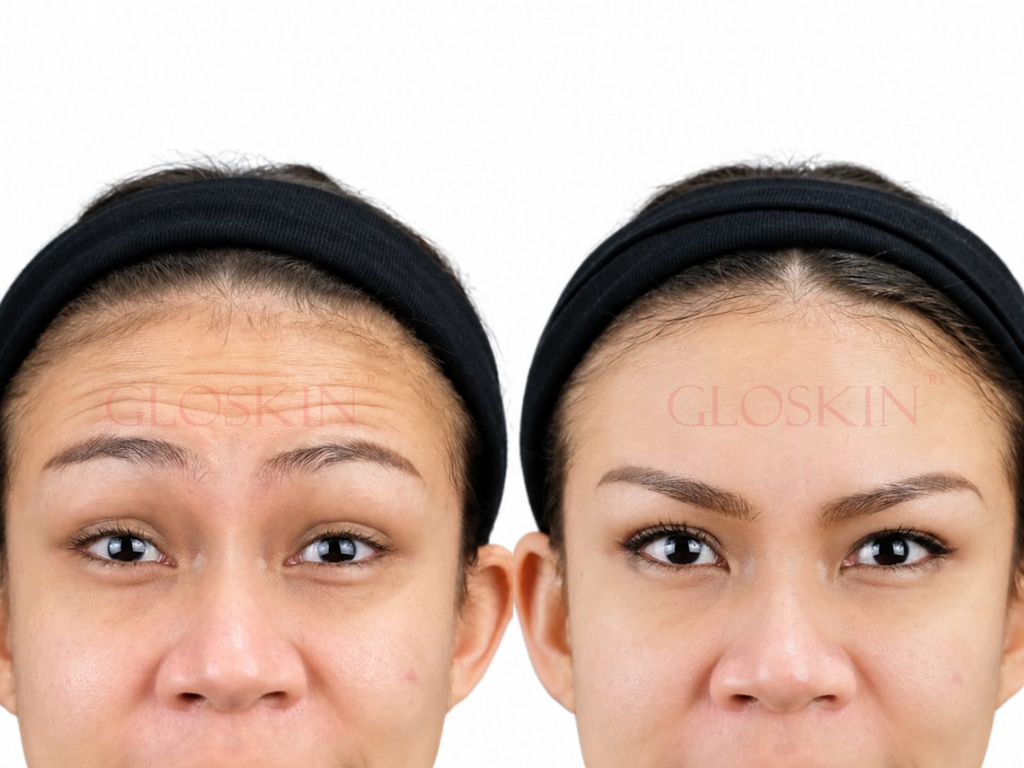 Botox