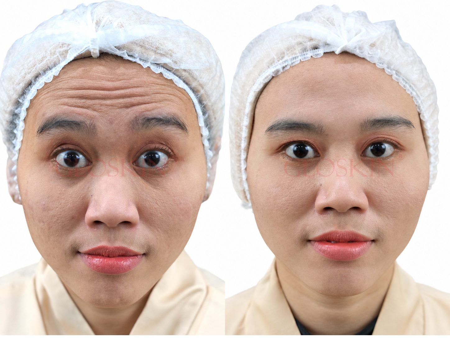 Botox