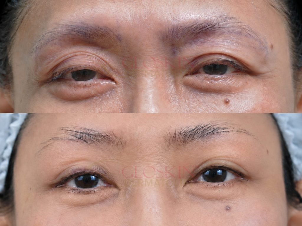 Brow Lift