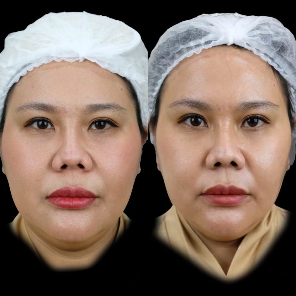 Buccal Fat