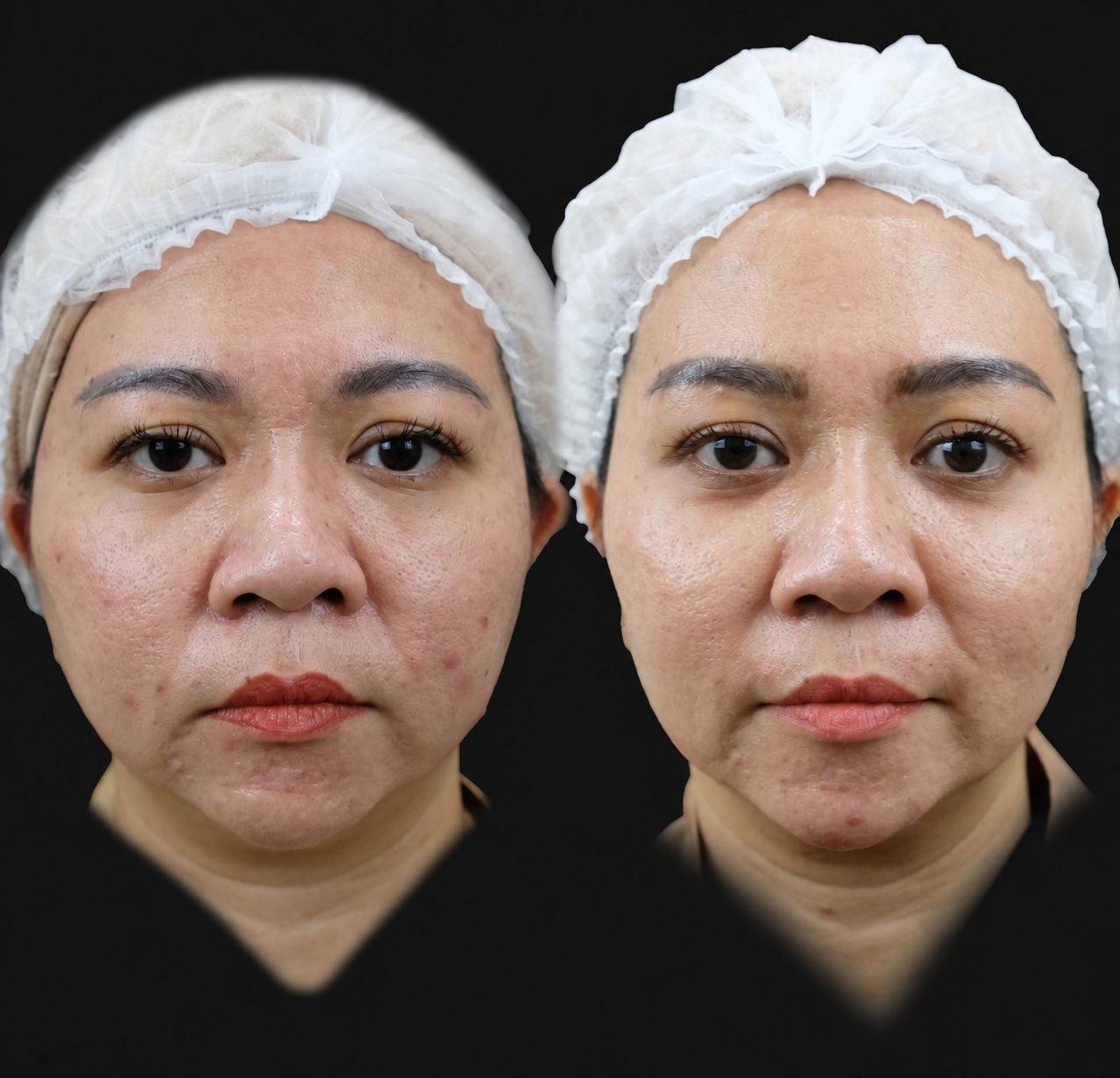 Buccal Fat