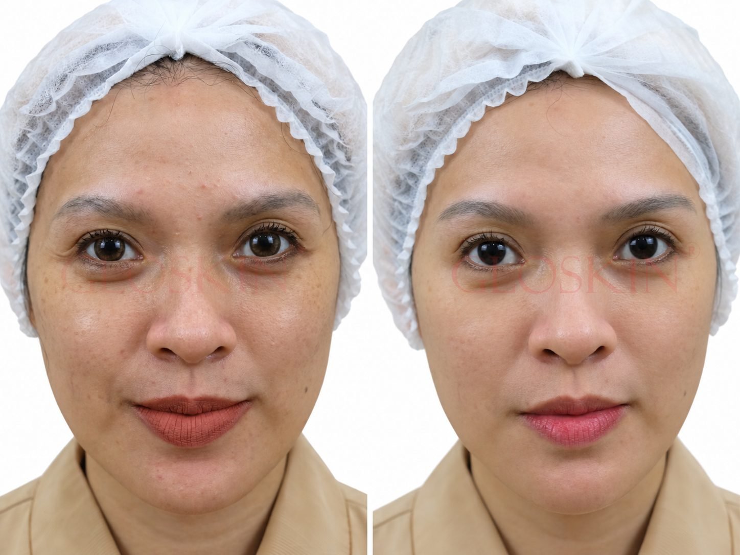 Derma Oxy Facial Therapy