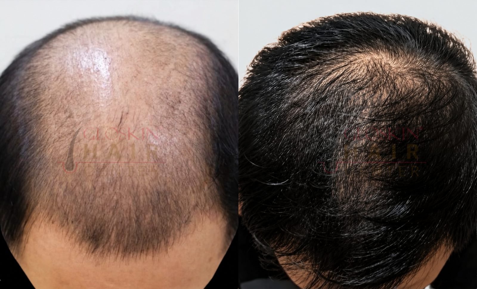 Exxohair