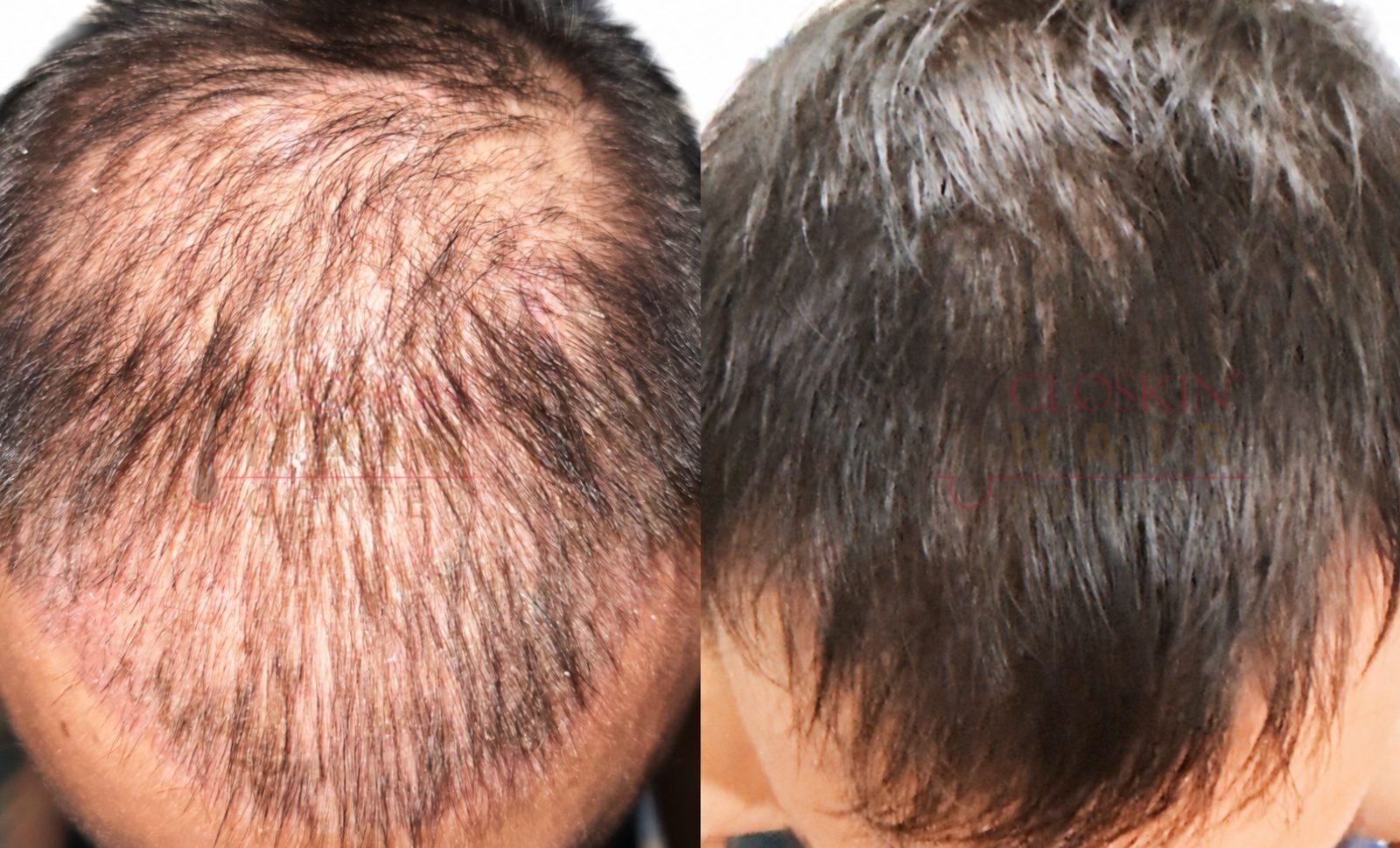Exxohair