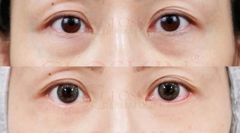 Eyebag Removal