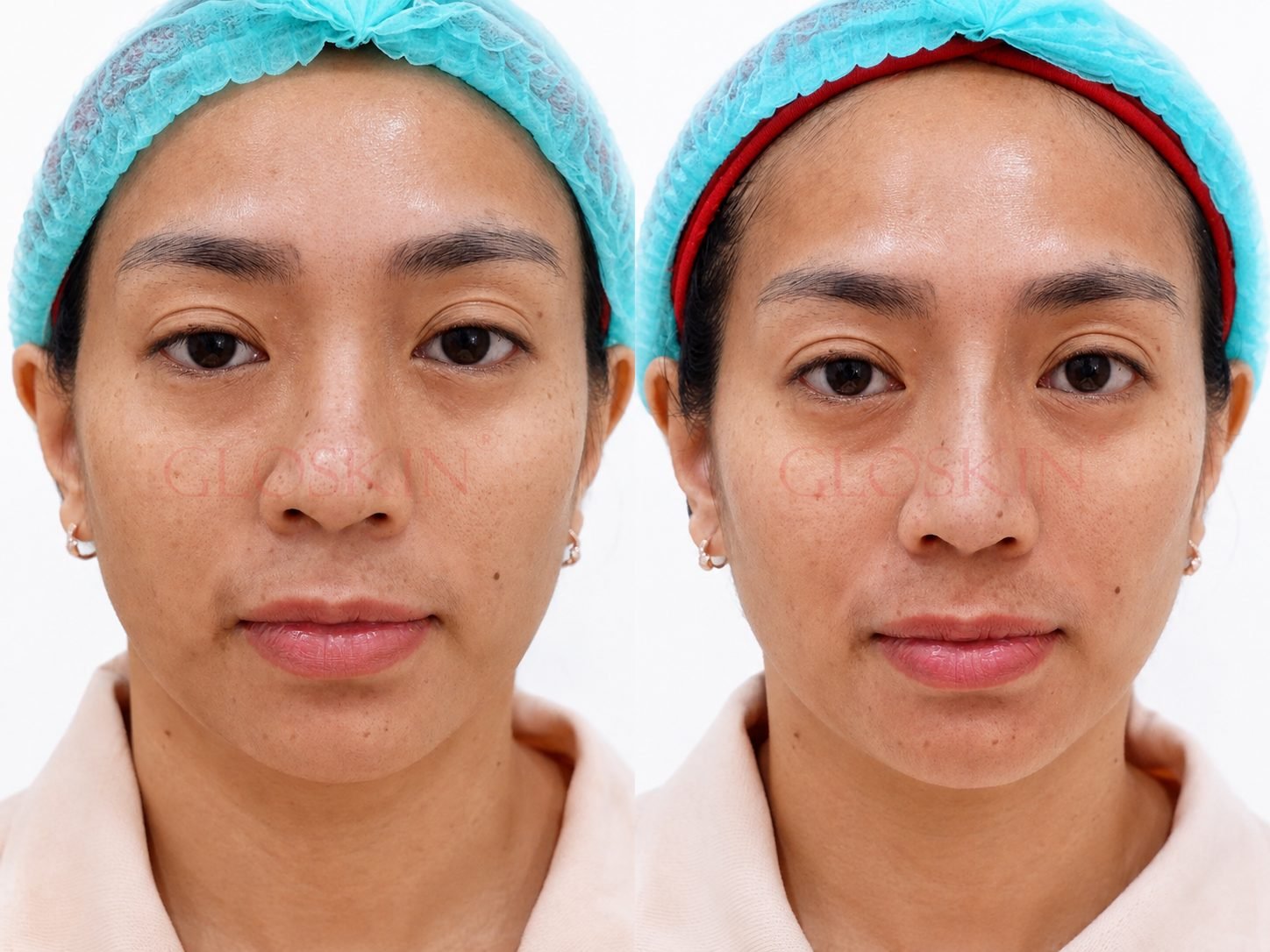Gloskin Thread Lift
