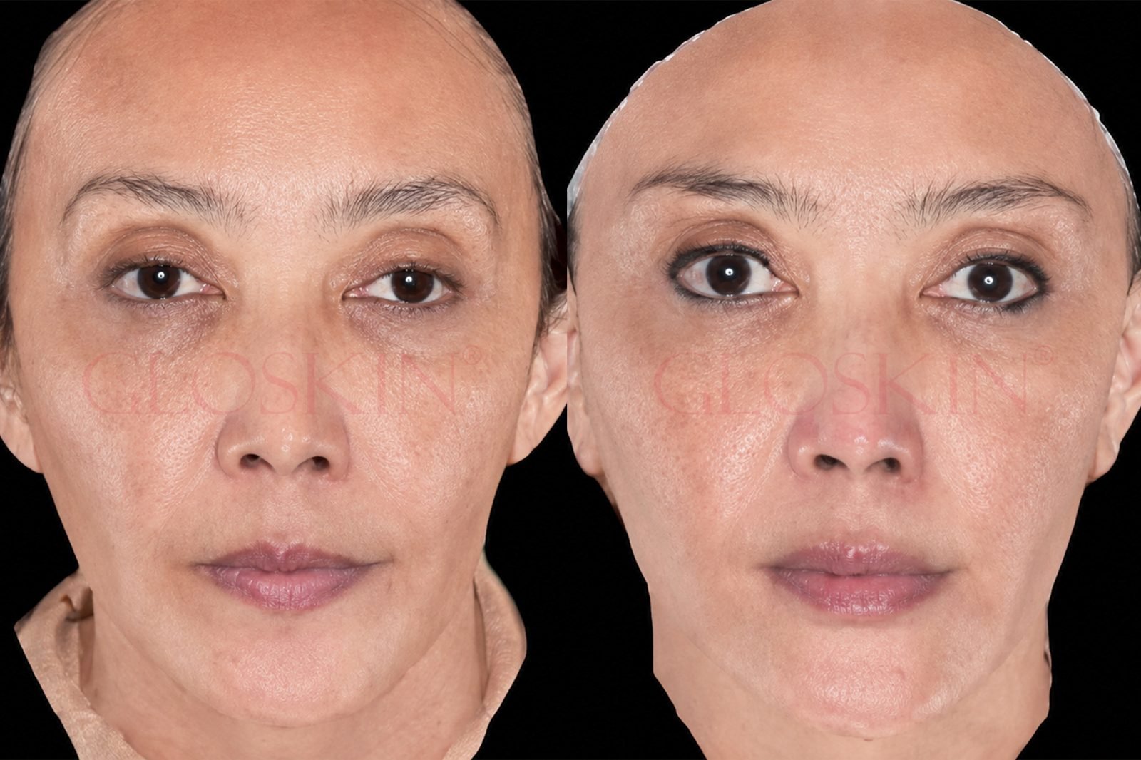 Gloskin Thread Lift