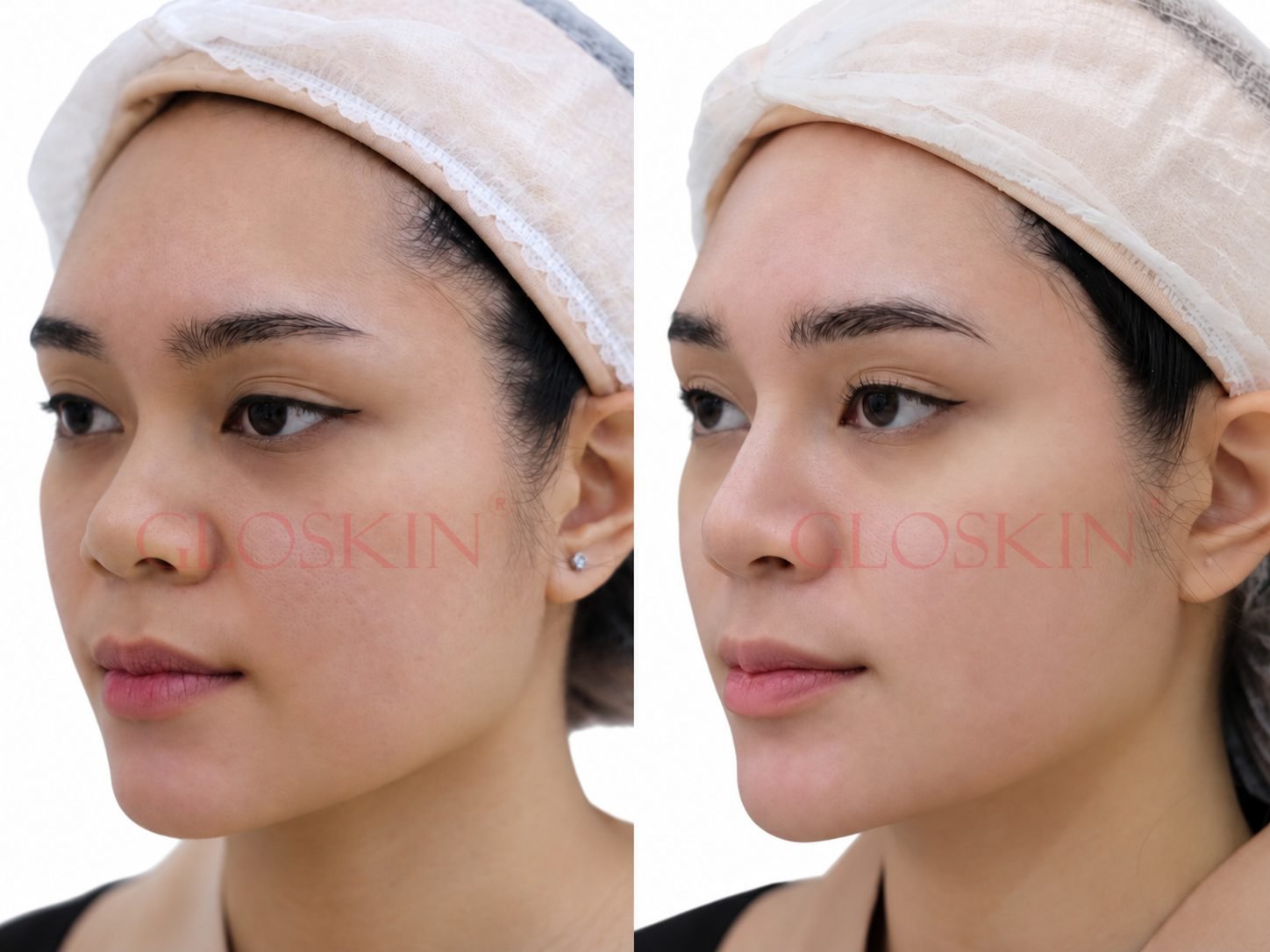 Gloskin Thread Lift