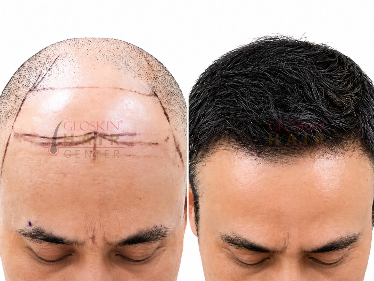 Hair Transplant