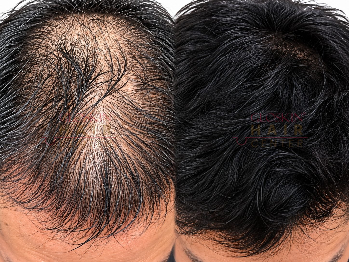 Hair Transplant