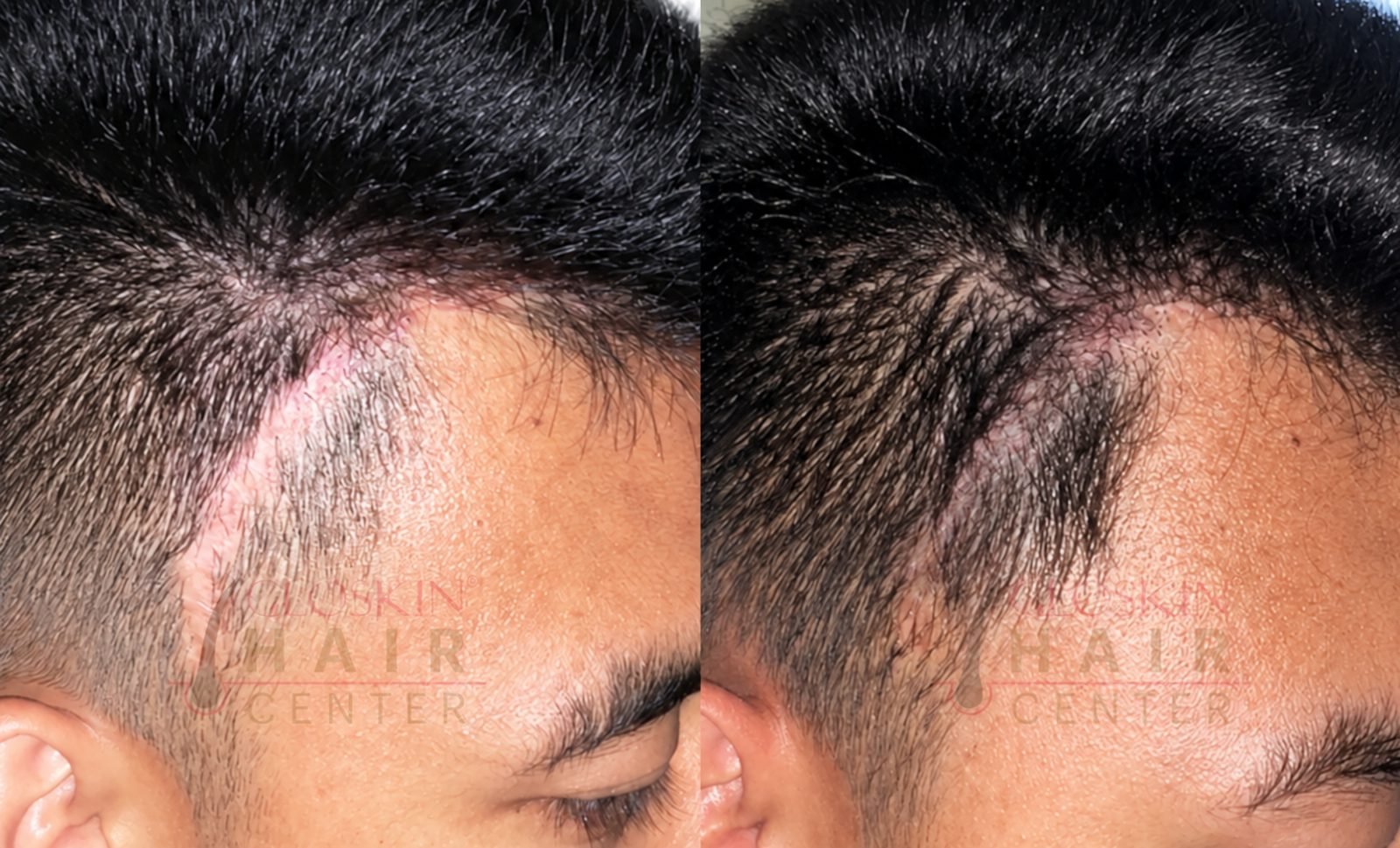 Hair Transplant
