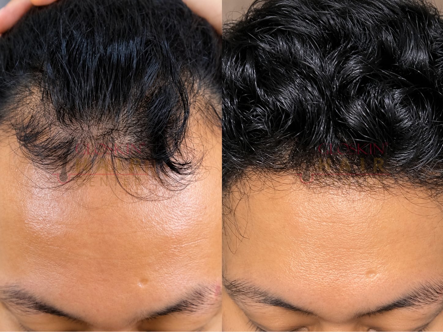 Hair Transplant