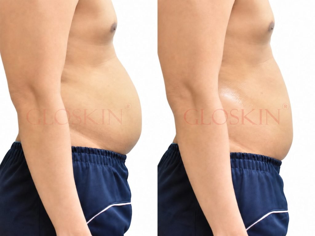 Hollywood Body Sculpting