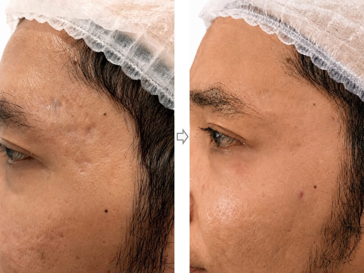 Ice Pick Scar