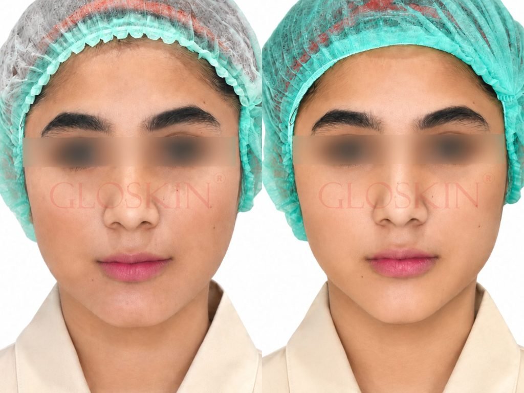 Jawline Shaping