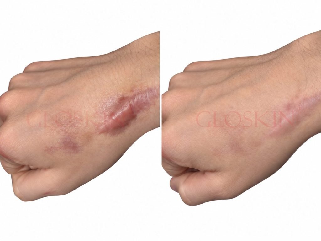 Keloid Injection