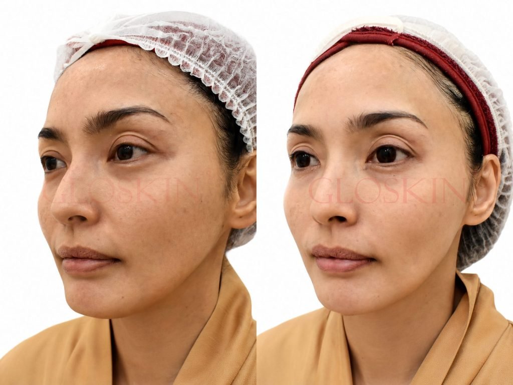 Korean Comedo Glowing Peel