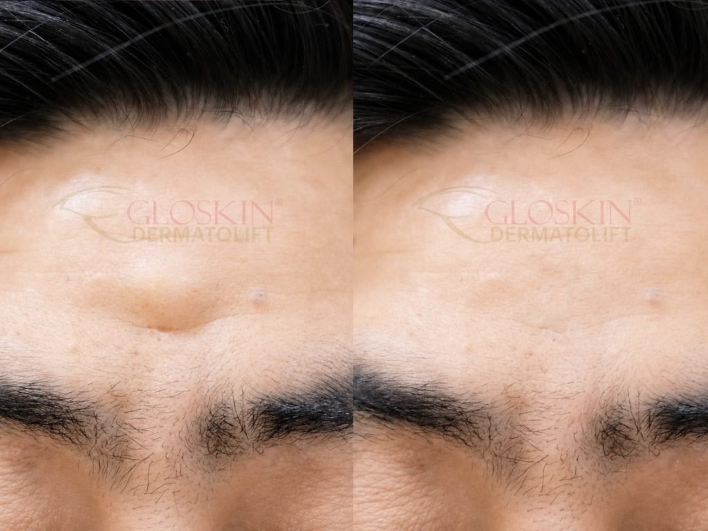 Lipoma Removal