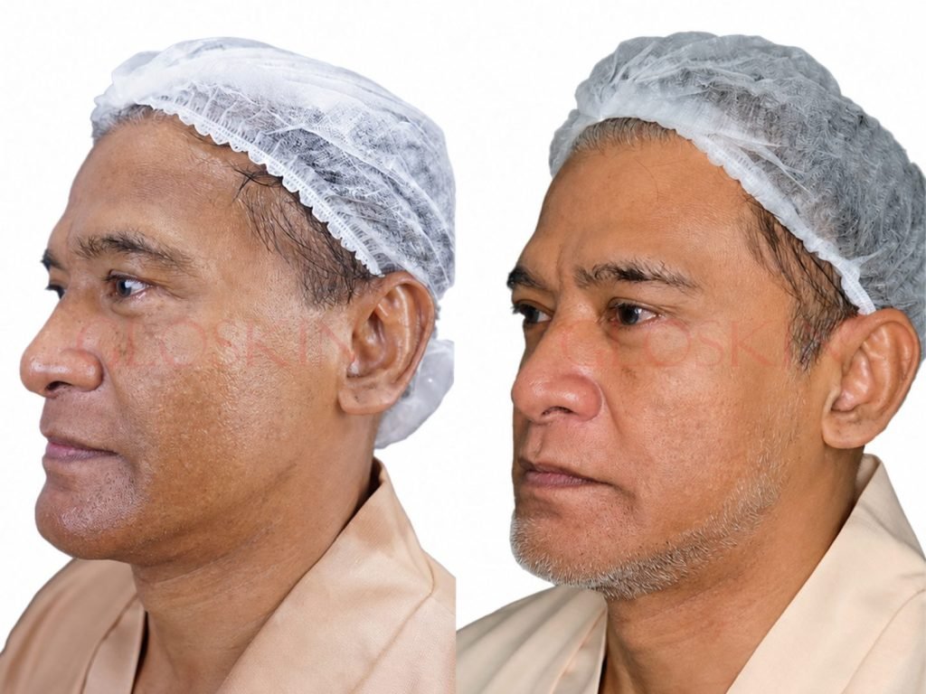 Pico Laser