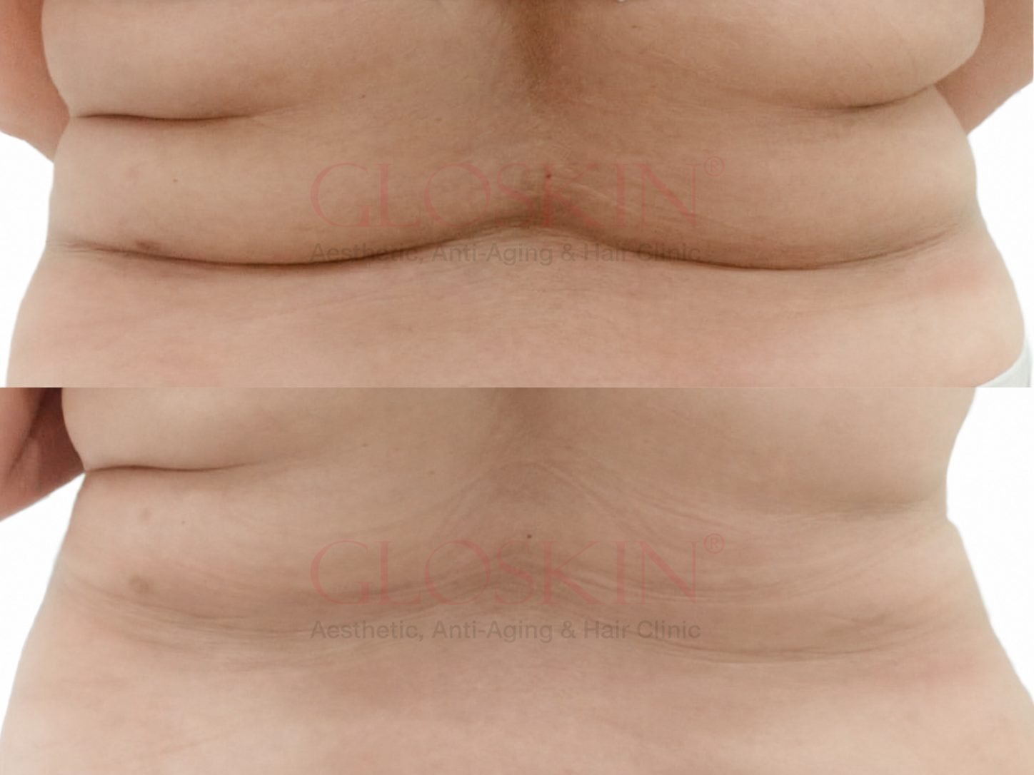 Radiofrequency