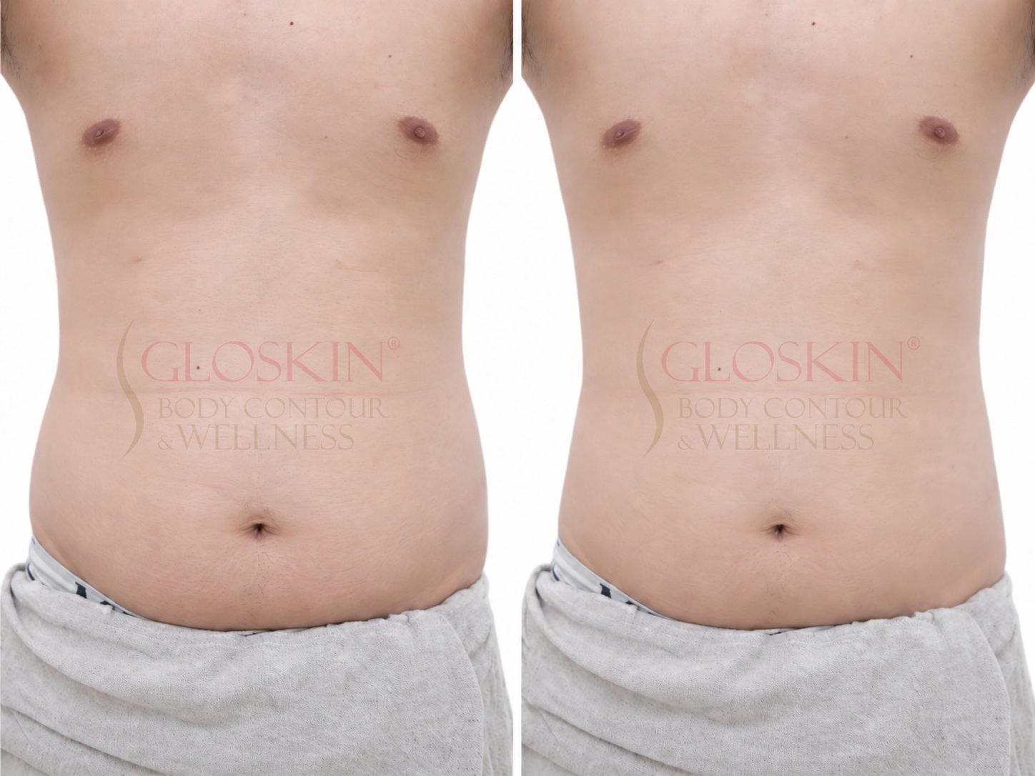 Radiofrequency