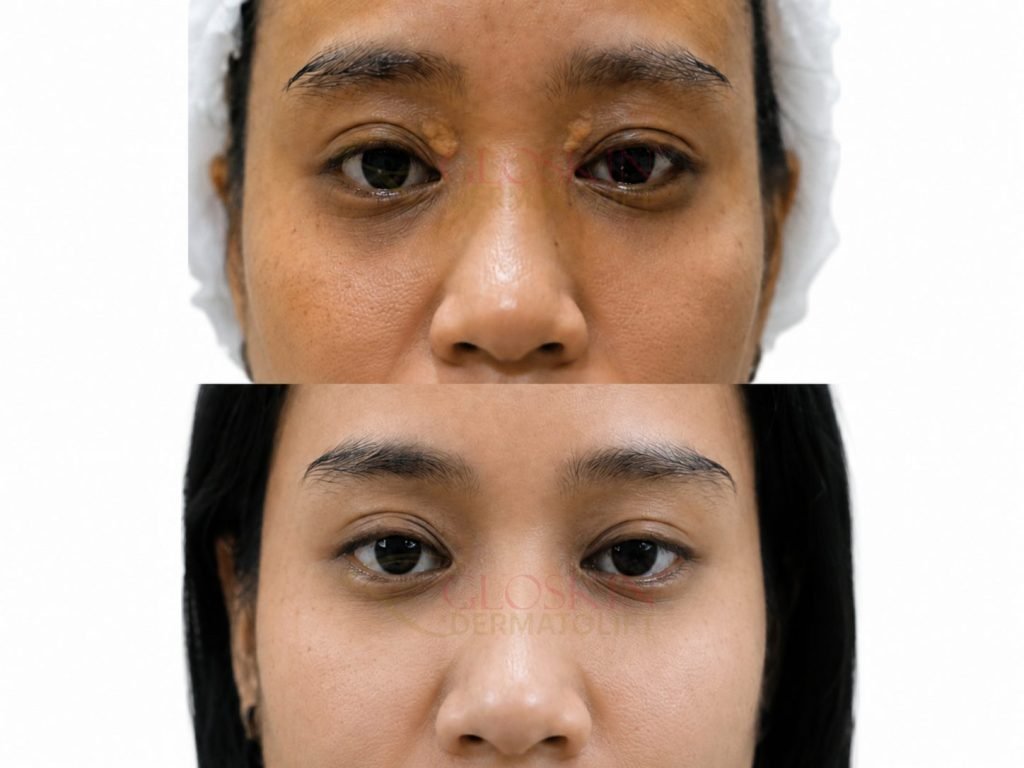 Xantelasma
